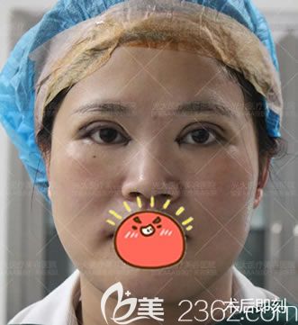 永康光大醫(yī)院剛做完雙眼皮照片 永康光大醫(yī)院剛做完雙眼皮照片