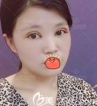 在永康光大做雙眼皮開(kāi)眼角3天后 在永康光大做雙眼皮開(kāi)眼角3天后