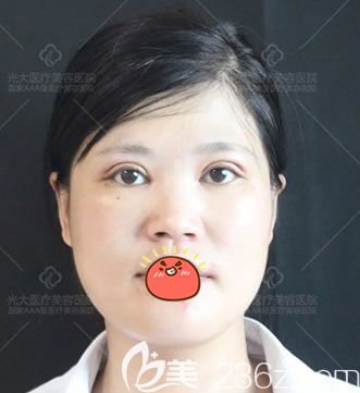 做完雙眼皮開(kāi)眼角7天拆線效果 做完雙眼皮開(kāi)眼角7天拆線效果