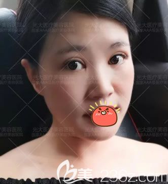 做完雙眼皮開(kāi)眼角15天恢復(fù)照 做完雙眼皮開(kāi)眼角15天恢復(fù)照