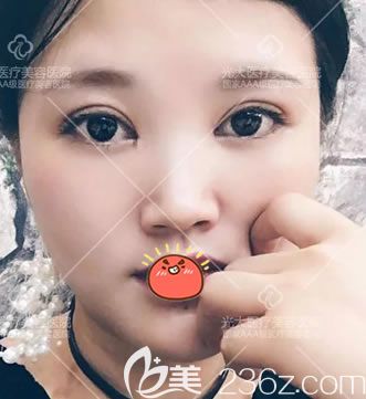 人生初次整形我選擇金華永康光大醫(yī)院郭院長(zhǎng)做了6mm全切開扇形雙眼皮和開內(nèi)眼角