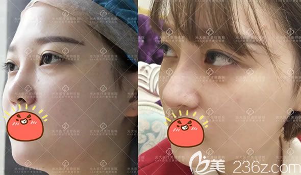 永康光大整形超體鼻綜合隆鼻案例 永康光大整形超體鼻綜合隆鼻案例