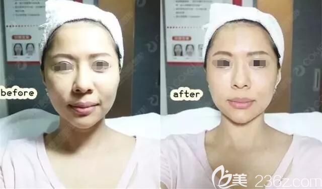注射伊婉玻尿酸除皺豐下巴術(shù)前術(shù)后即刻對比