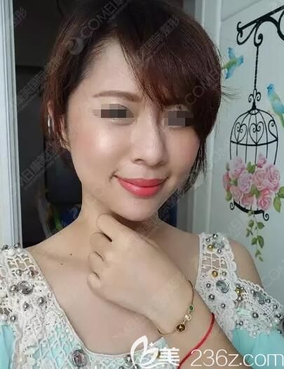 趁著伊婉玻尿酸有優(yōu)惠價格到南通康美填充改善法令紋凹陷淚溝還順帶給下巴也注射了一支