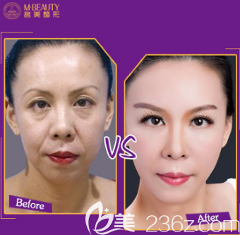 填充自體脂肪對(duì)比案例