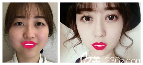 邯鄲金煌后2019整形優(yōu)惠狂歡購 雙眼皮和只需750元