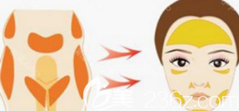 脂肪移植示意圖