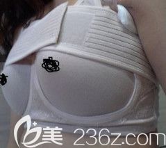 劉云濤院長(zhǎng)為我做假體隆胸7天后堅(jiān)持穿塑胸衣 劉云濤院長(zhǎng)為我做假體隆胸7天后堅(jiān)持穿塑胸衣