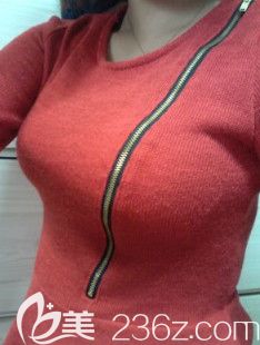 經(jīng)秦皇島念奴嬌劉云濤院長做完曼托假體隆胸術(shù)后 終于體會到將D罩杯內(nèi)衣填滿的感覺