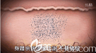 清除黑色素效率高