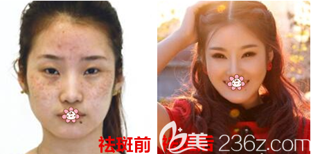 重慶藝星整形皮秒祛斑效果怎么樣