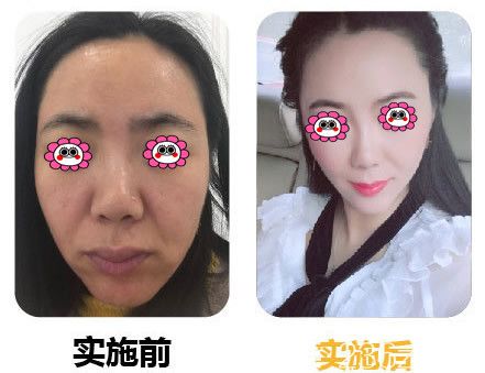 瘦臉變化圖