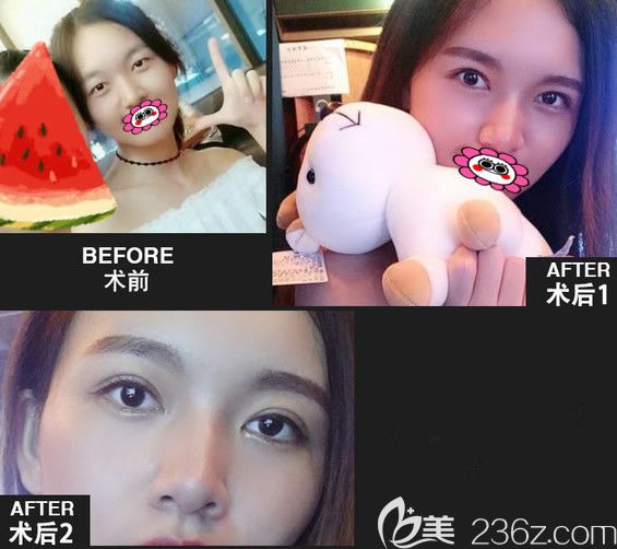 廈門臉博士林建新雙眼皮效果圖