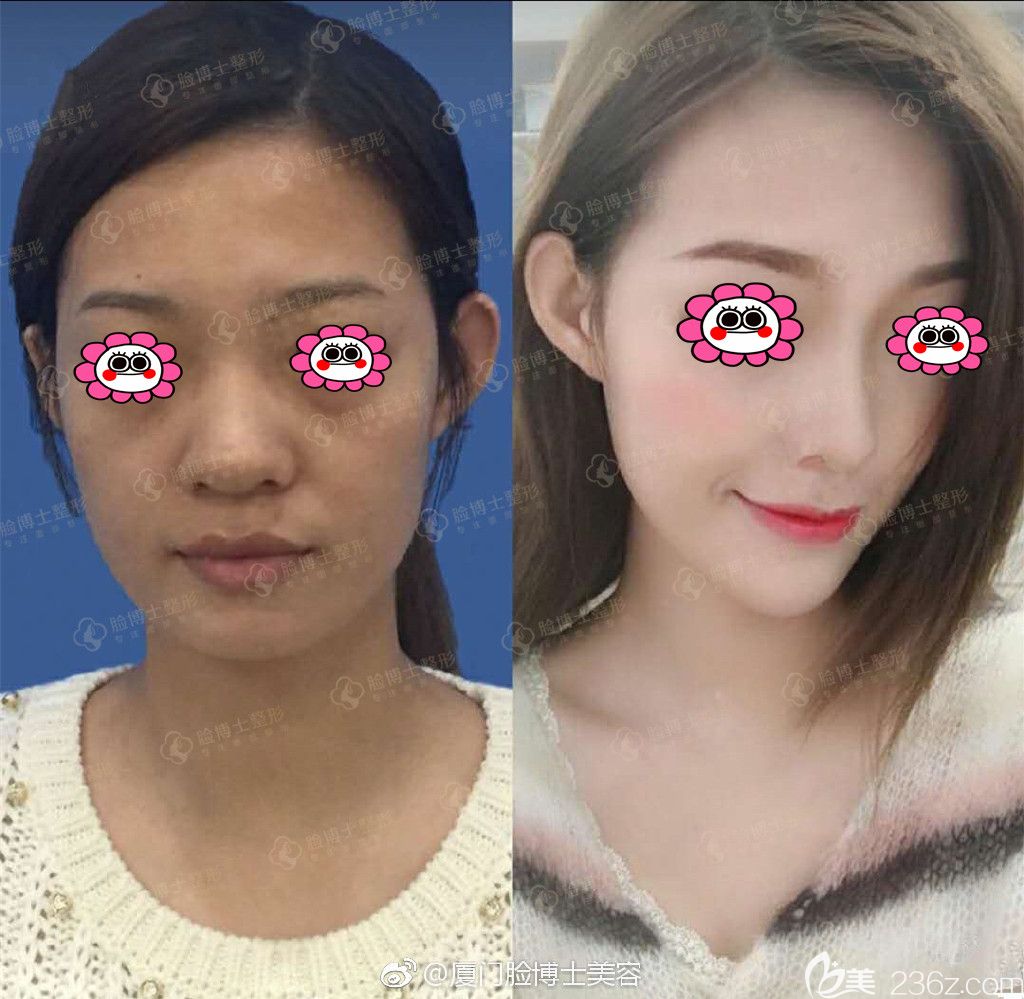 廈門臉博士整形賈洪仁隆鼻變化圖