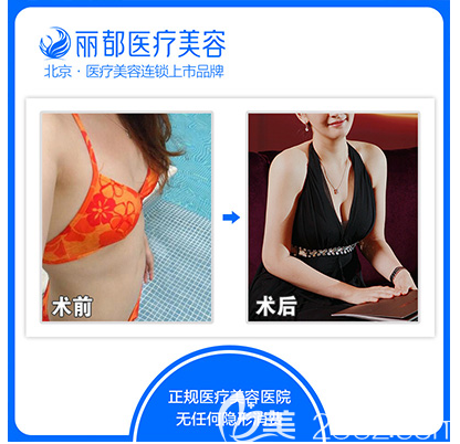 北京米蘭柏羽麗都高海燕脂肪豐胸案例