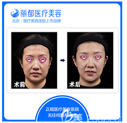 北京米蘭柏羽麗都高艷瘦臉除皺瘦臉案例
