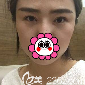 北京畫(huà)美雙眼皮修復(fù)<span style= 北京畫(huà)美雙眼皮修復(fù)<span style=