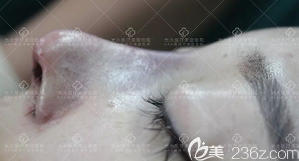 在永康光大整形做完鼻子即刻效果