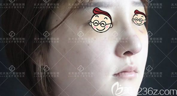 做完鼻綜合隆鼻7天恢復(fù)照