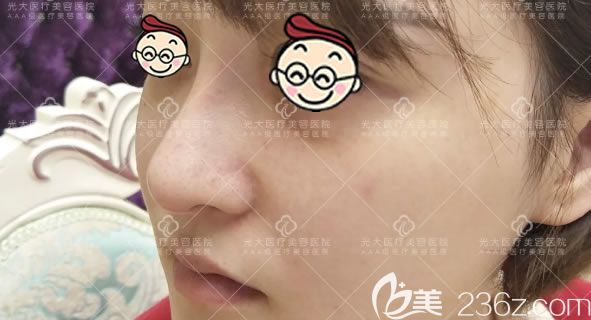 做完膨體和軟骨鼻綜合30天后