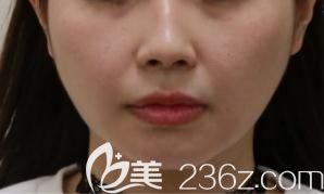 日本哪個(gè)醫(yī)生做面部吸脂好?東京銀座Prime醫(yī)院高澤博和讓我從丑小鴨變白天鵝