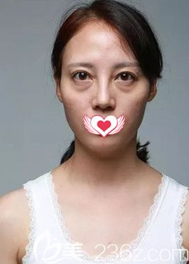 在秦皇島巧致做脂肪填充面部前面部干癟顯老 在秦皇島巧致做脂肪填充面部前面部干癟顯老