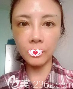 王立英院長為我做完脂肪填充面部后微腫 王立英院長為我做完脂肪填充面部后微腫