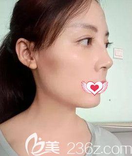 擔(dān)心注射玻尿酸填充面部會很假 所以選擇秦皇島巧致做了自體脂肪面部填充術(shù)