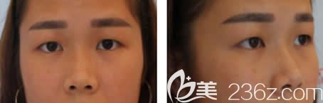 我在南寧夢(mèng)想整形做眼綜合前的照片 我在南寧夢(mèng)想整形做眼綜合前的照片