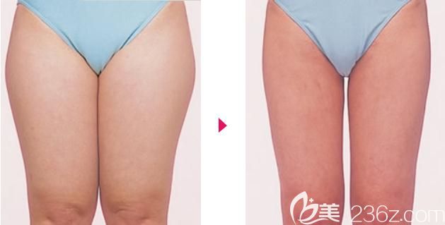 元神賢太給我做大腿吸脂前后對(duì)比