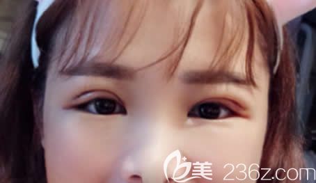 南寧夢(mèng)想唐超給我做全切雙眼皮術(shù)后第4天 南寧夢(mèng)想唐超給我做全切雙眼皮術(shù)后第4天