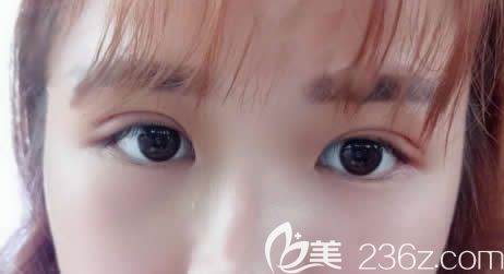 我在南寧夢(mèng)想做切開(kāi)雙眼皮加開(kāi)眼角術(shù)后第8天 我在南寧夢(mèng)想做切開(kāi)雙眼皮加開(kāi)眼角術(shù)后第8天