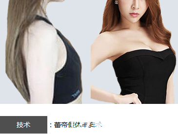宜昌蕾帝整形醫(yī)院假體隆胸案例效果對比圖 宜昌蕾帝整形醫(yī)院假體隆胸案例效果對比圖