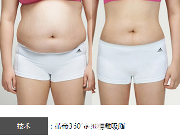 宜昌蕾帝整形醫(yī)院360°多維精雕吸脂效果對比圖 宜昌蕾帝整形醫(yī)院360°多維精雕吸脂效果對比圖