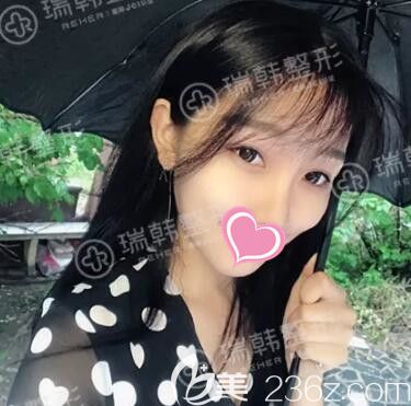 術(shù)后20天恢復(fù)效果 術(shù)后20天恢復(fù)效果