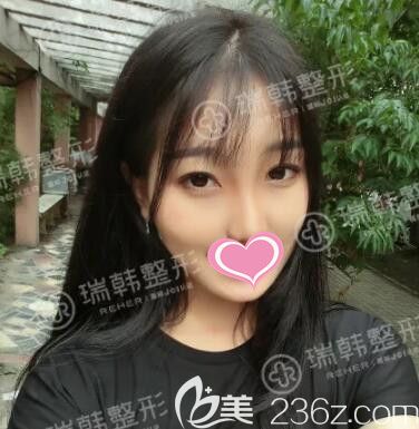 做自體脂肪填充面部+蘿莉大眼術(shù)后1個月效果 做自體脂肪填充面部+蘿莉大眼術(shù)后1個月效果