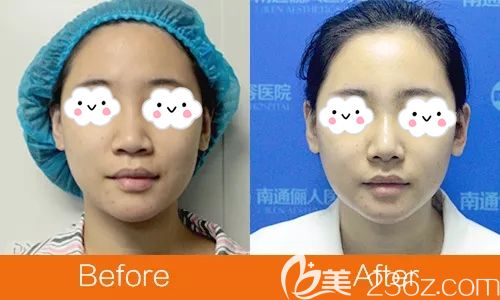 南通儷人連天美做假體隆鼻真人案例