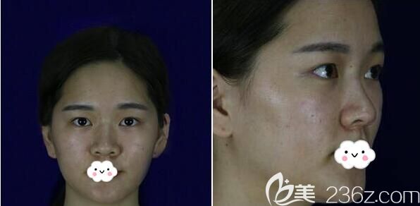 四川友誼醫(yī)院整形美容科雷蕾術(shù)前照片1