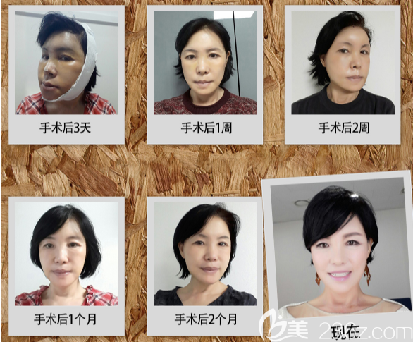 宋志英術(shù)后3個(gè)月的恢復(fù)過程 宋志英術(shù)后3個(gè)月的恢復(fù)過程