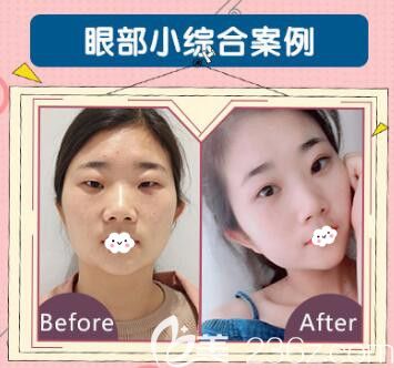 荊州華美李杰雙眼皮+開眼角+提肌+去脂去皮案例