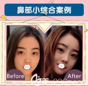 荊州華美李杰鼻綜合案例效果對比圖