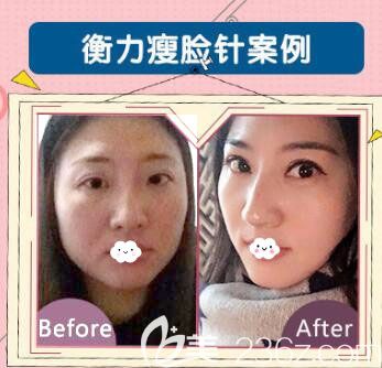 荊州華美注射瘦臉除皺瘦臉案例