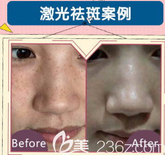 荊州華美激光祛斑真人案例效果對比圖