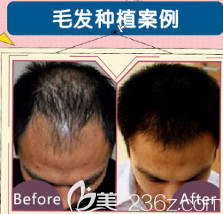 荊州華美頭頂加密種植效果對比圖