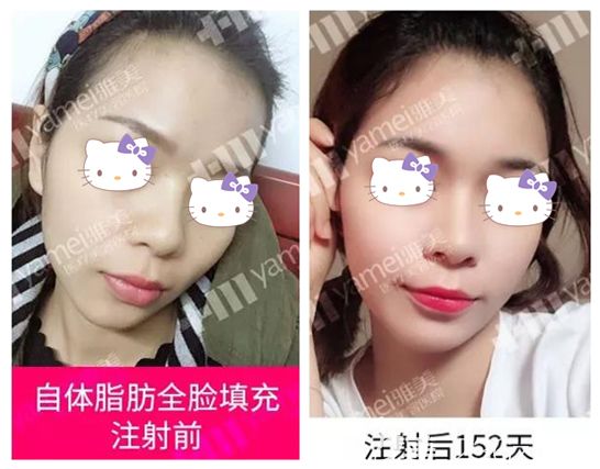 廖偉龍主任做自體脂肪面部填充152天后效果