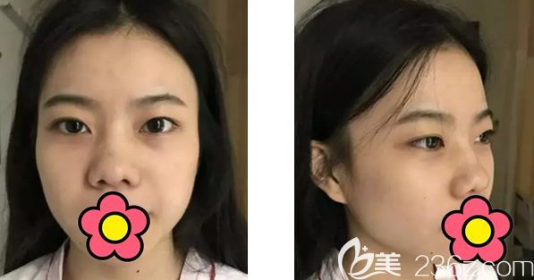 呼和浩特五洲整形隆鼻+全切雙眼皮前 呼和浩特五洲整形隆鼻+全切雙眼皮前