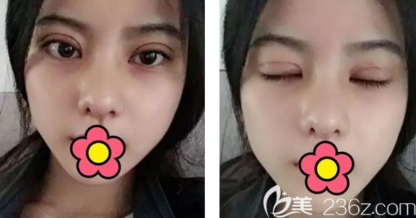 切開雙眼皮+半肋軟骨隆鼻第三天 切開雙眼皮+半肋軟骨隆鼻第三天