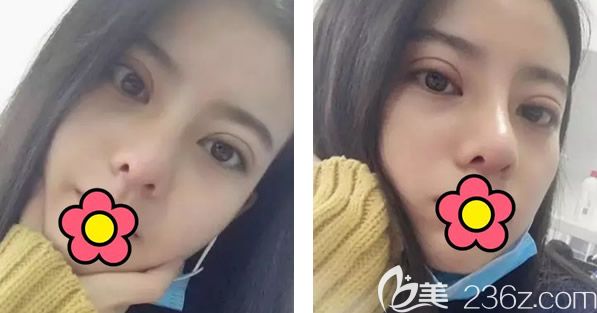 呼市五洲割雙眼皮隆鼻第七天拆線 呼市五洲割雙眼皮隆鼻第七天拆線