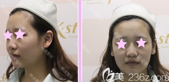 我在南寧韓成整形做全臉自體脂肪填充前照片 我在南寧韓成整形做全臉自體脂肪填充前照片