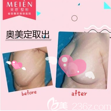 廣州美恩許揚(yáng)濱奧美定取出+假體隆胸案例 廣州美恩許揚(yáng)濱奧美定取出+假體隆胸案例